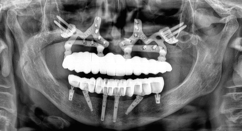Radiografía donde se puede observar el anclaje de las mallas subperiosticas en los dos maxilares